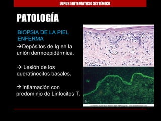 LUPUS ERITEMATOSO SISTÉMICO



PATOLOGÍA
BIOPSIA DE LA PIEL
ENFERMA
Depósitos de Ig en la
unión dermoepidérmica.

 Lesión de los
queratinocitos basales.

 Inflamación con
predominio de Linfocitos T.
 