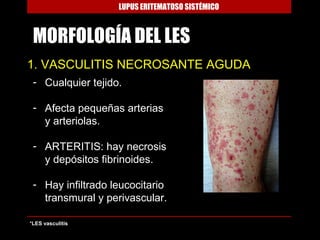 LUPUS ERITEMATOSO SISTÉMICO



 MORFOLOGÍA DEL LES
1. VASCULITIS NECROSANTE AGUDA
 - Cualquier tejido.

 - Afecta pequeñas arterias
   y arteriolas.

 - ARTERITIS: hay necrosis
   y depósitos fibrinoides.

 - Hay infiltrado leucocitario
   transmural y perivascular.

*LES vasculitis
 