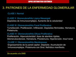 LUPUS ERITEMATOSO SISTÉMICO


3. PATRONES DE LA ENFERMEDAD GLOMERULAR
  CLASE I: Normal

  CLASE II: Glomerulonefritis Lúpica Mesangial:
  Depósitos de Inmunocomplejos. Aumento de la celularidad

  CLASE III: Glomerulonefritis Focal Proliferativa:
  Tumefacción. Proliferación. Infiltración. Depósitos fibrinoides. Hematuria.
  Proteinuria.
  CLASE IV: Glomerulonefritis Difusa Proliferativa:
  Proliferación. Hipercelularidad. Asas de alambre rígidas.
  Glomerulosclerosis. Hematuria. Preoteinuria. Hipertensión. Insuf renal.
  CLASE V: Glomerulonefritis Membranosa:
  Engrosamiento de la pared capilar. Depósito. Acumulación de
  Inmunocomplejos. Proteinuria con Sind. Nefrótico manifiesto.

  De acuerdo a la OMS
 
