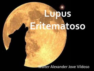 Lupus
Eritematoso


 Walter Alexander Jove Vildoso
 