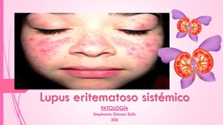 Lupus eritematoso sistémico
PATOLOGÍA
Stephanie Gómez Solís
306
 