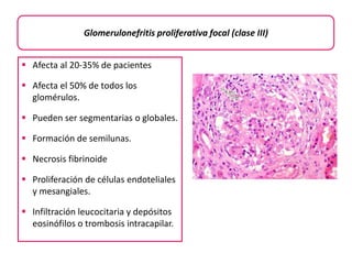 Glomerulonefritis proliferativa focal (clase III) 
 Afecta al 20-35% de pacientes 
 Afecta el 50% de todos los 
glomérulos. 
 Pueden ser segmentarias o globales. 
 Formación de semilunas. 
 Necrosis fibrinoide 
 Proliferación de células endoteliales 
y mesangiales. 
 Infiltración leucocitaria y depósitos 
eosinófilos o trombosis intracapilar. 
 