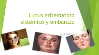 Lupus eritematoso
sistémico y embarazo
Hernández Davila
 