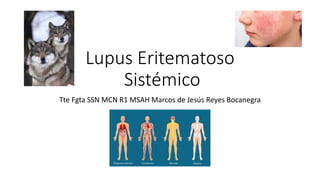 Lupus Eritematoso
Sistémico
Tte Fgta SSN MCN R1 MSAH Marcos de Jesús Reyes Bocanegra
 