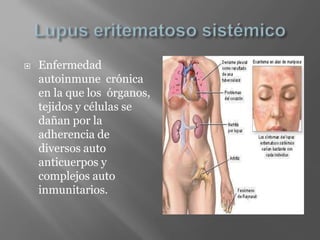  Enfermedad
autoinmune crónica
en la que los órganos,
tejidos y células se
dañan por la
adherencia de
diversos auto
anticuerpos y
complejos auto
inmunitarios.
 