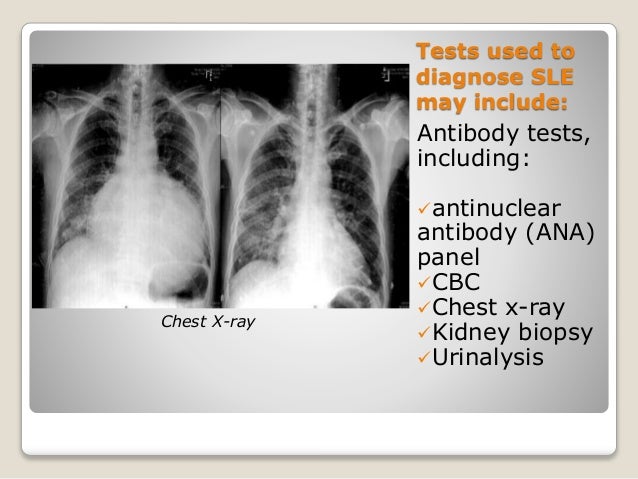 sle chest x report lupus erythematosis sle chest x report lupus erythematosis
