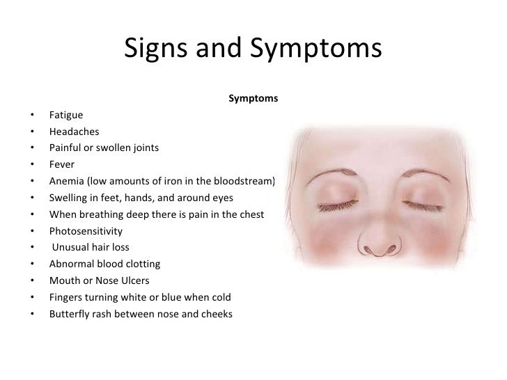 Lupus Final Presentation