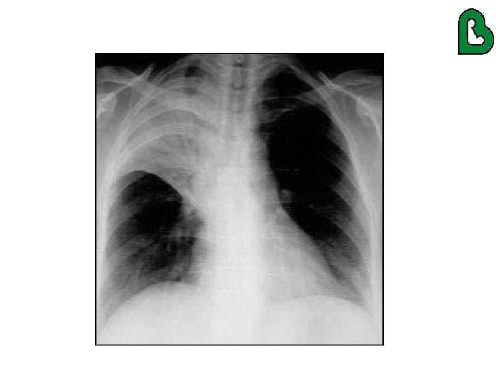 Lupus and the Lungs by Dr. Gilda DiazFuentes