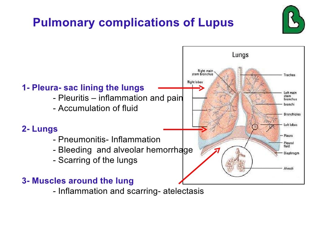 Lupus and the Lungs by Dr. Gilda DiazFuentes