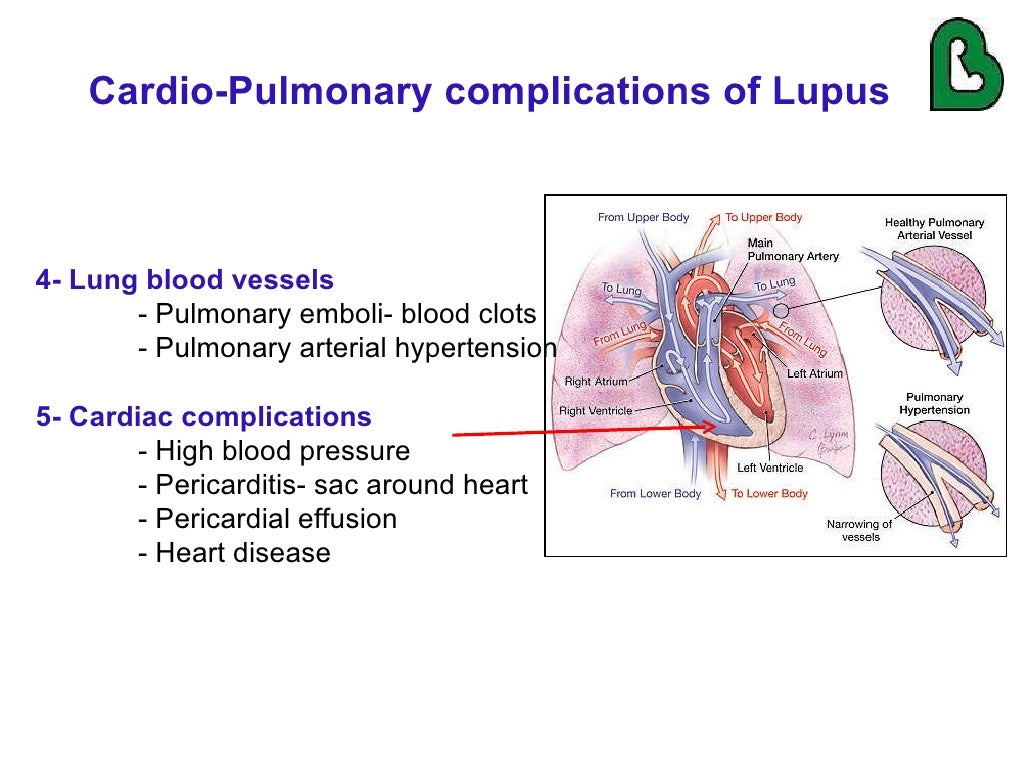 Lupus and the Lungs by Dr. Gilda DiazFuentes