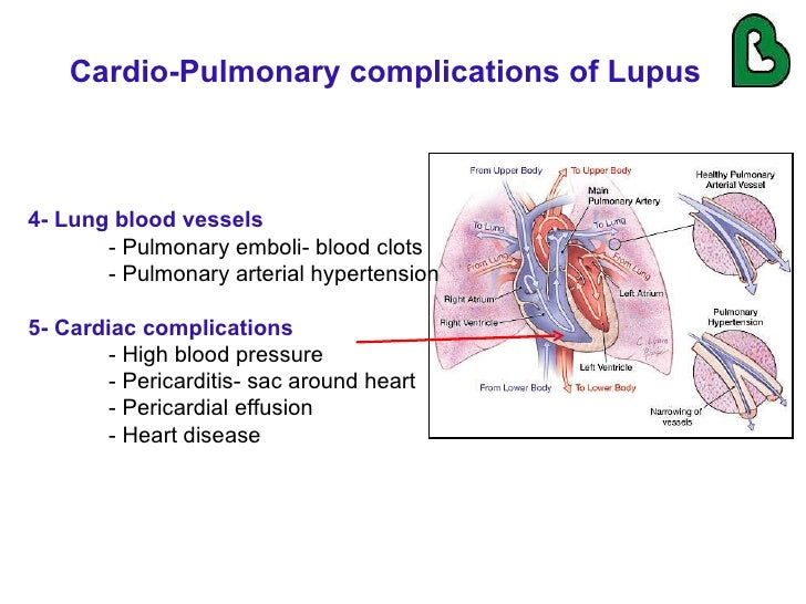 Image result for lupus cardiovascular complications