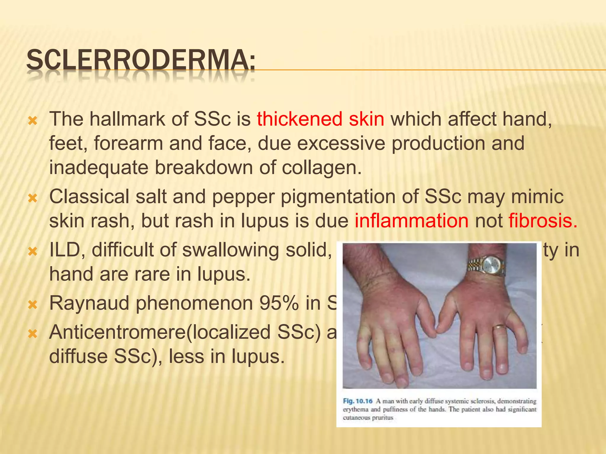 Lupus mimicker2.pptx