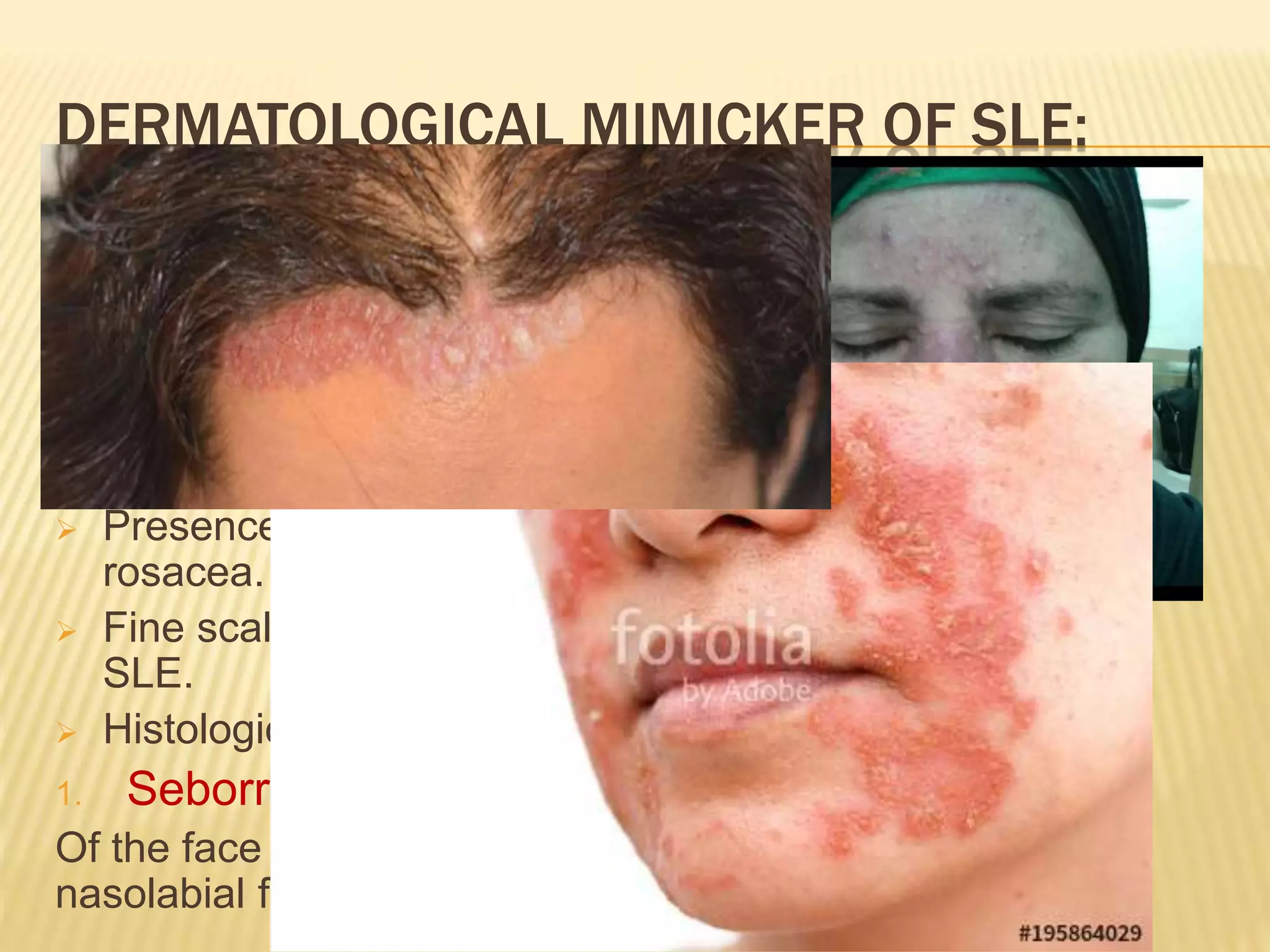 Lupus mimicker2.pptx