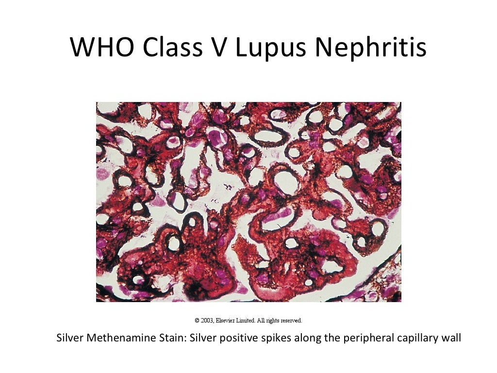 Lupus Nephritis