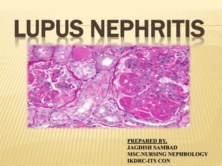 LUPUS NEPHRITIS
PREPARED BY,
JAGDISH SAMBAD
MSC.NURSING NEPHROLOGY
IKDRC-ITS CON
 