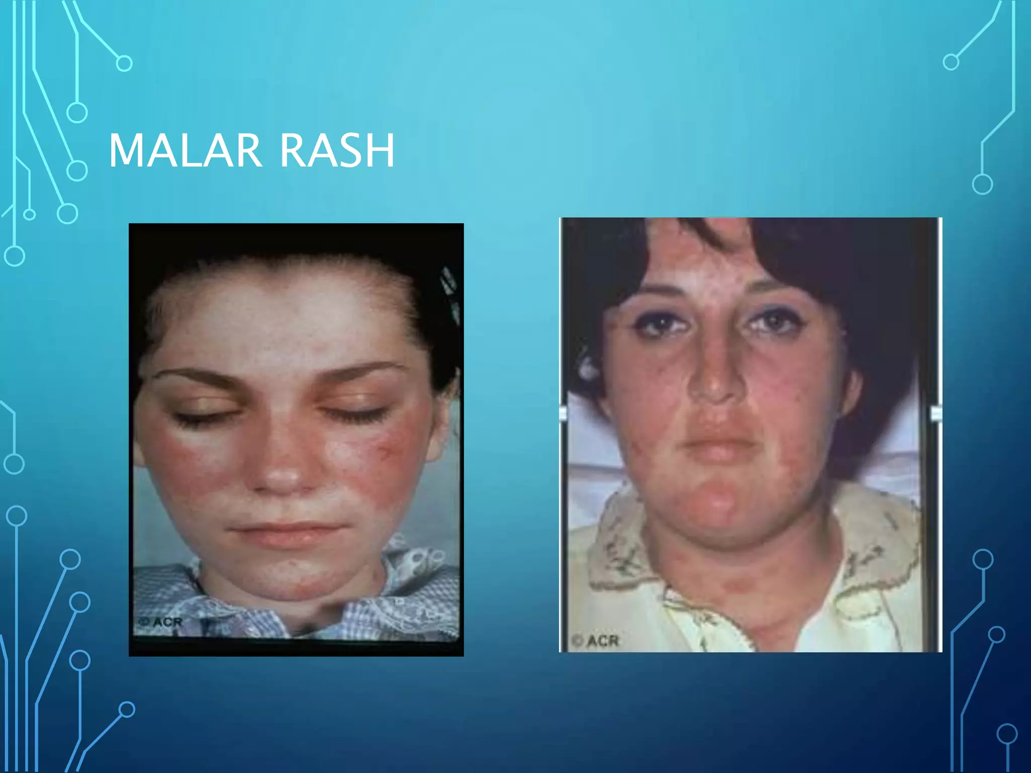 MALAR RASH
 