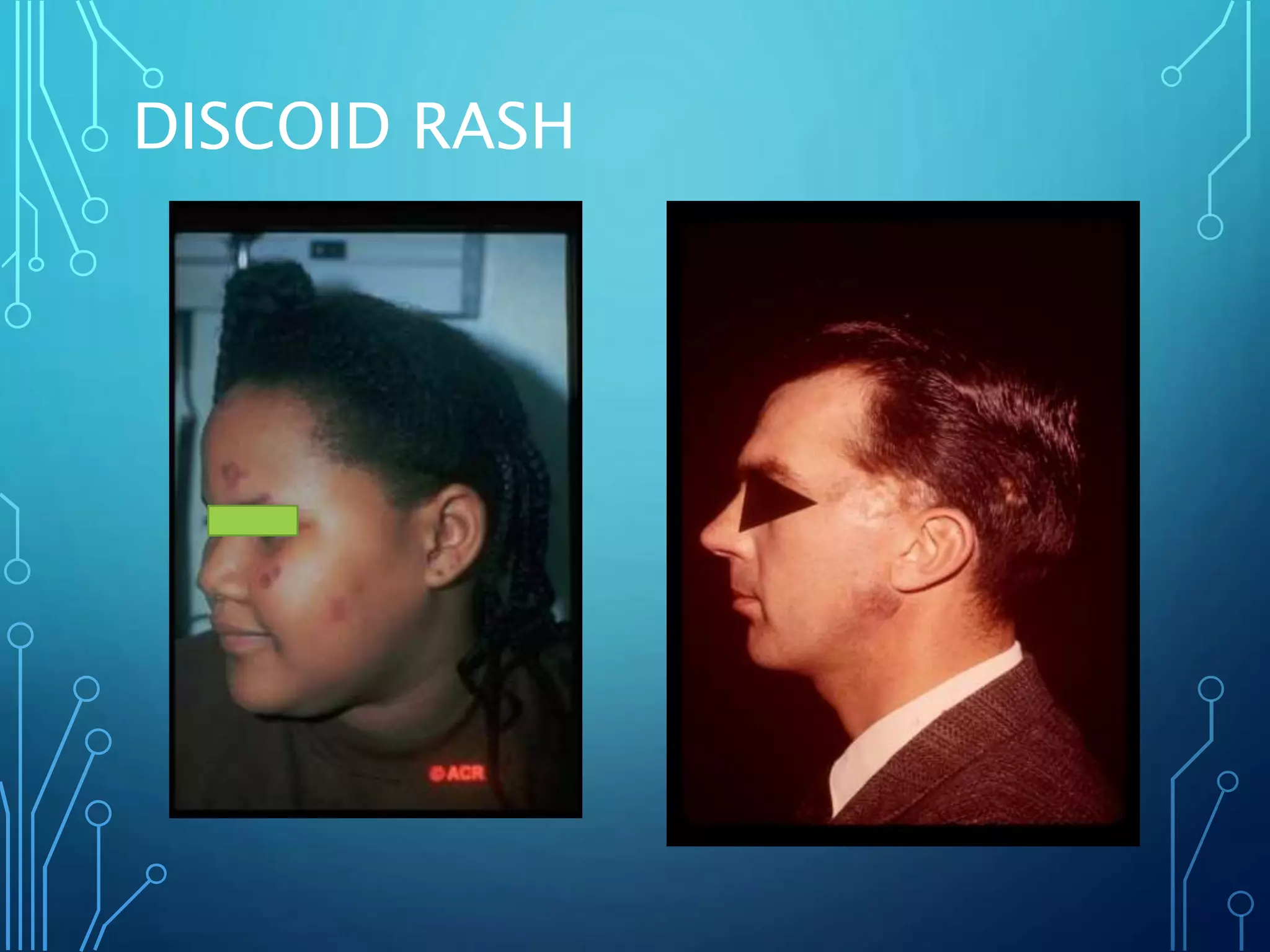 DISCOID RASH
 