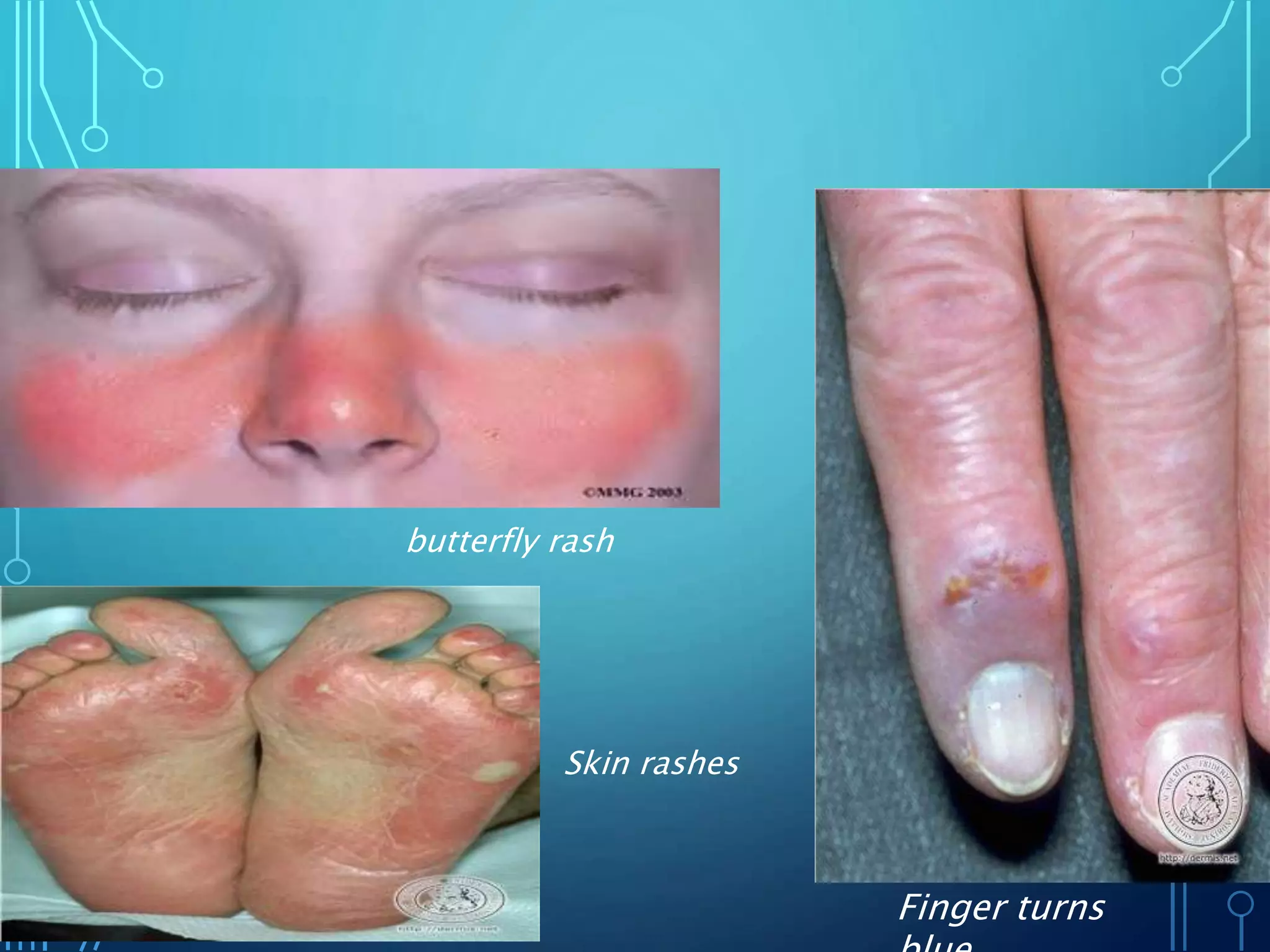 butterfly rash
Finger turns
Skin rashes
 