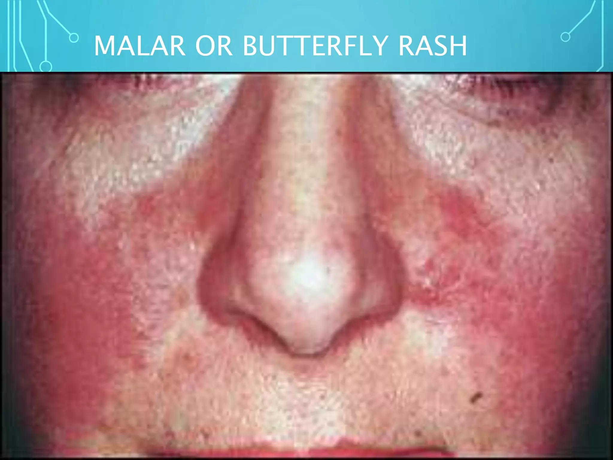 MALAR OR BUTTERFLY RASH
 