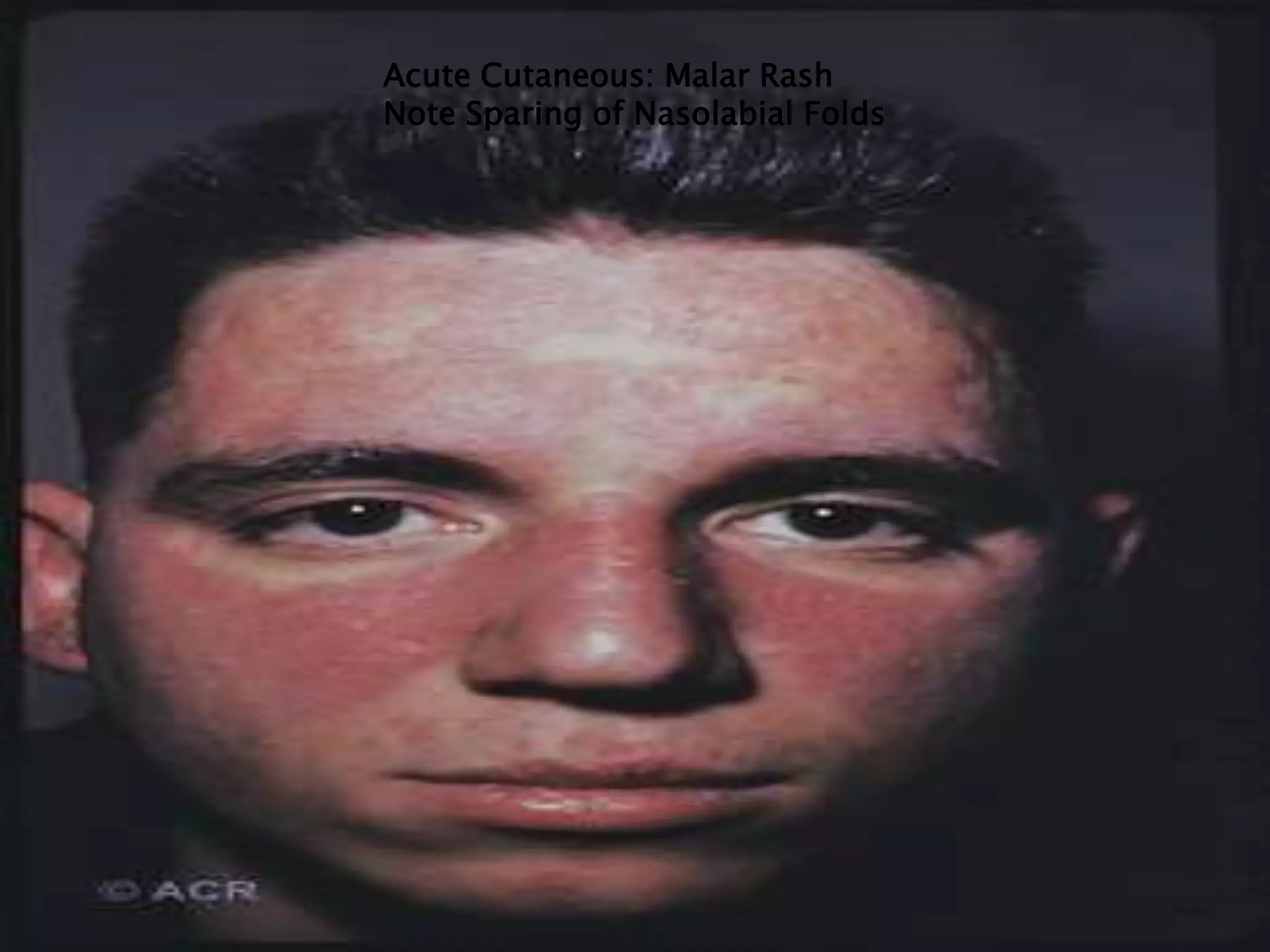 Acute Cutaneous: Malar Rash
Note Sparing of Nasolabial Folds
 