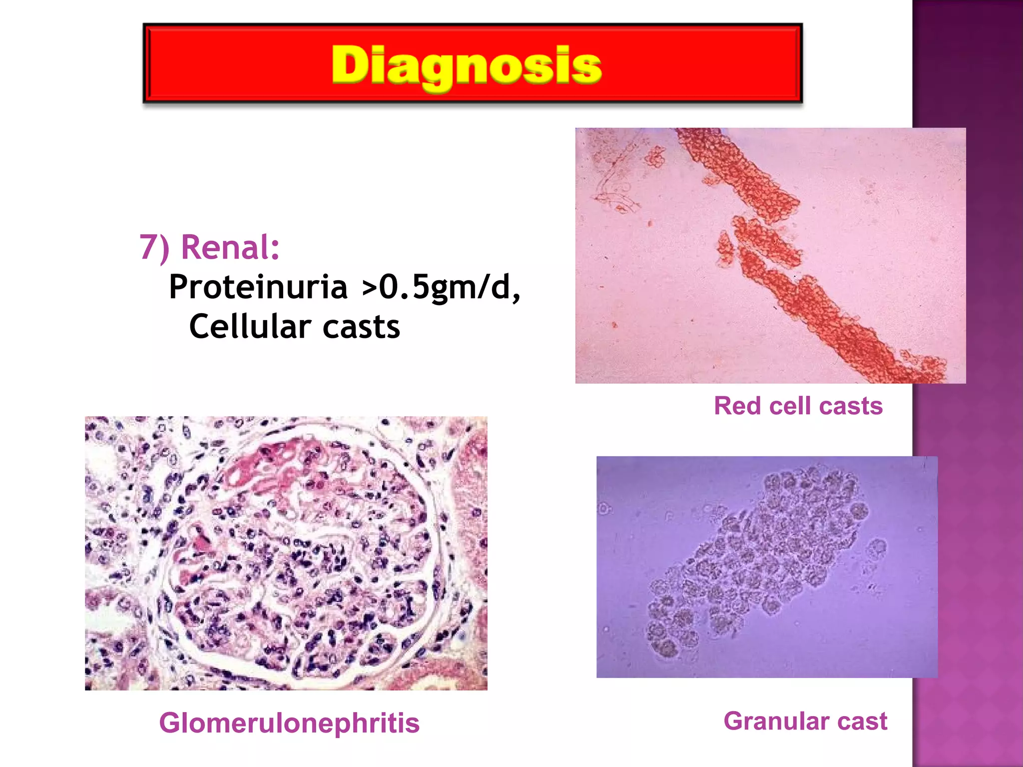 7) Renal:
Proteinuria >0.5gm/d,
Cellular casts
Red cell casts
Granular castGlomerulonephritis
 
