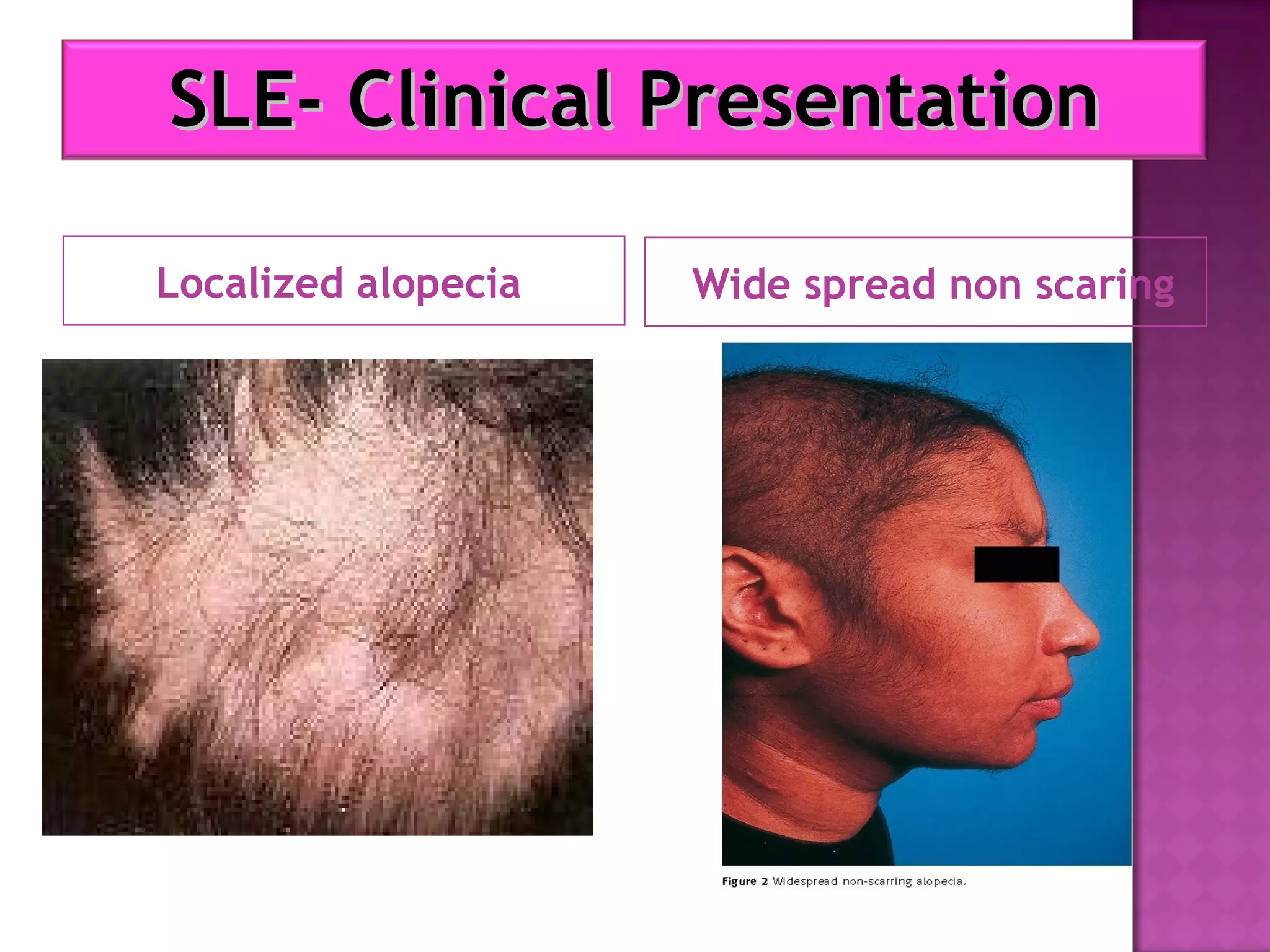 Localized alopecia Wide spread non scaring
SLE- Clinical PresentationSLE- Clinical Presentation
 