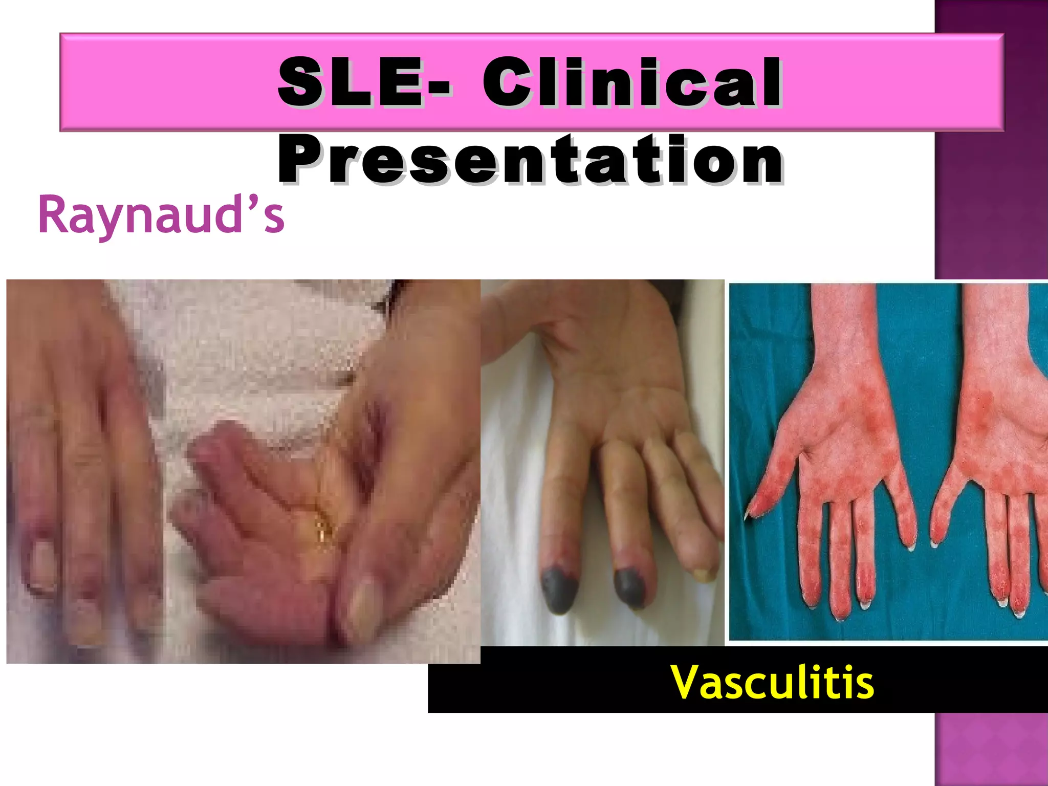 SLE- ClinicalSLE- Clinical
PresentationPresentation
Vasculitis
Raynaud’s
 