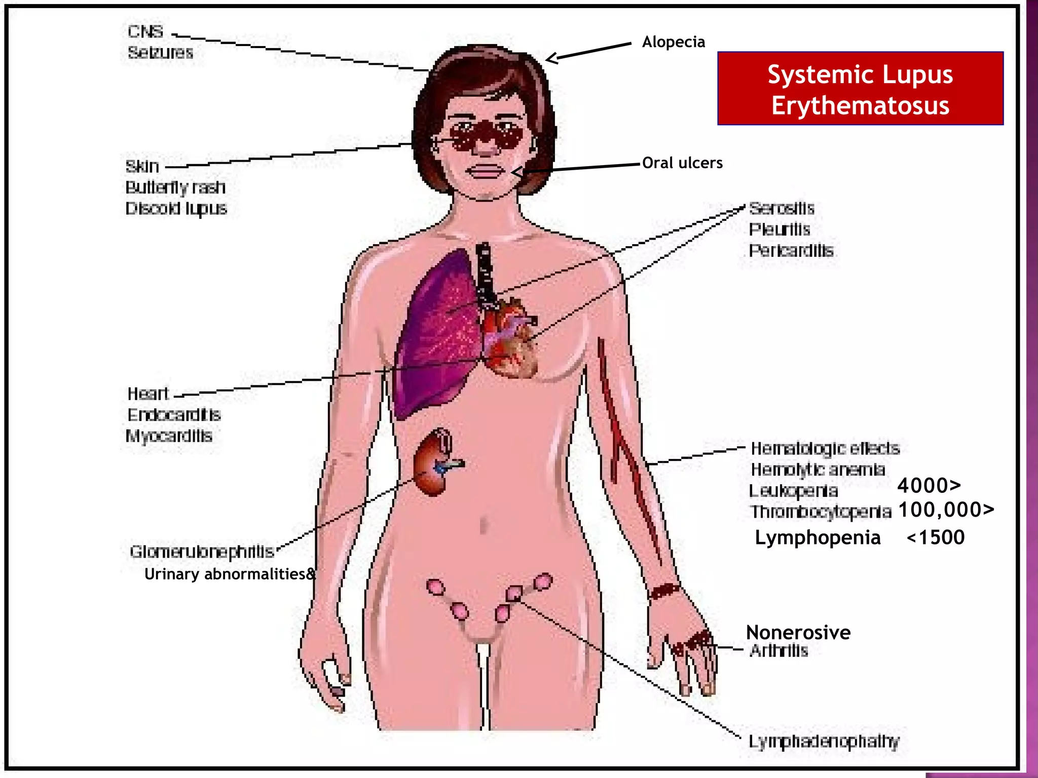 Alopecia
Oral ulcers
&Urinary abnormalities
Nonerosive
>4000
>100,000
Lymphopenia <1500
Systemic Lupus
Erythematosus
 