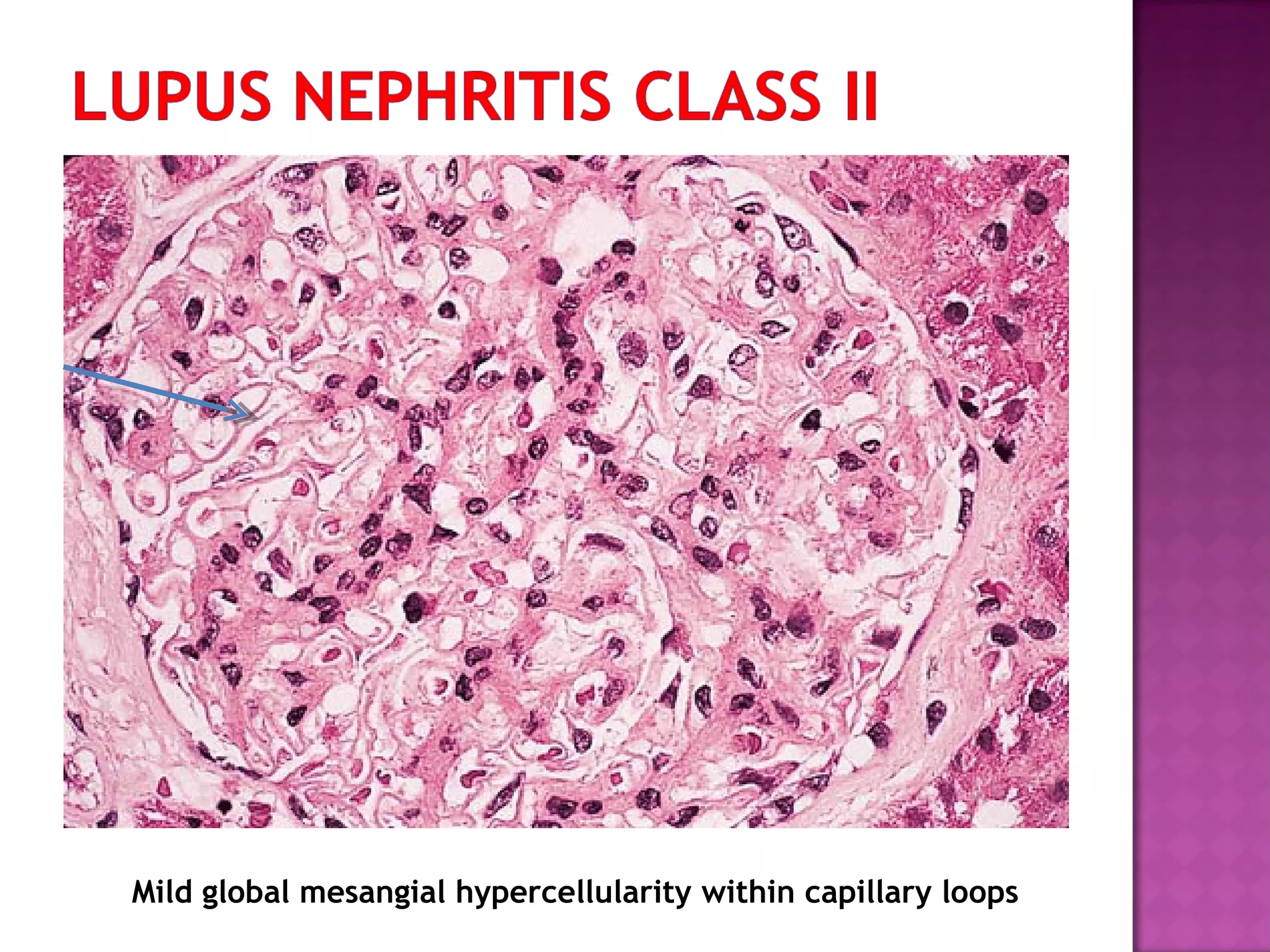 Mild global mesangial hypercellularity within capillary loops
 