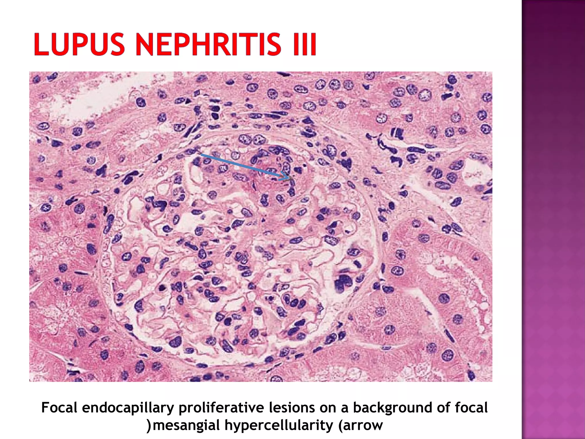 Focal endocapillary proliferative lesions on a background of focal
mesangial hypercellularity (arrow(
 