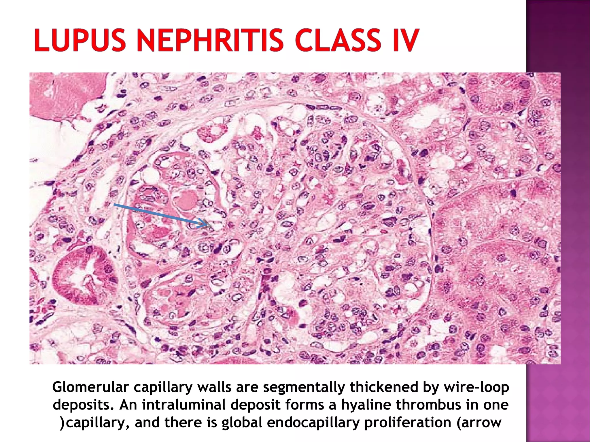Glomerular capillary walls are segmentally thickened by wire-loop
deposits. An intraluminal deposit forms a hyaline thrombus in one
capillary, and there is global endocapillary proliferation (arrow(
 
