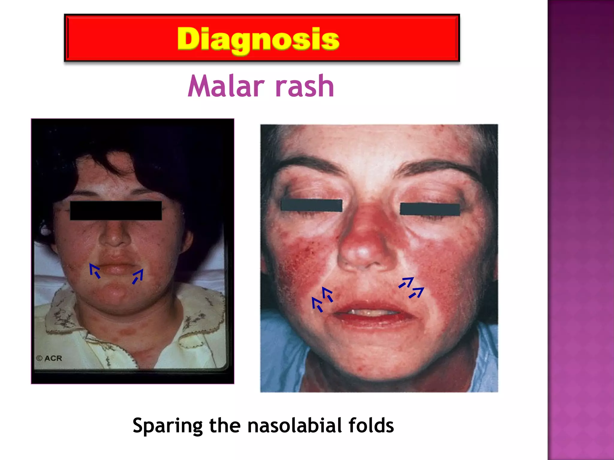 Sparing the nasolabial folds
Malar rash
 