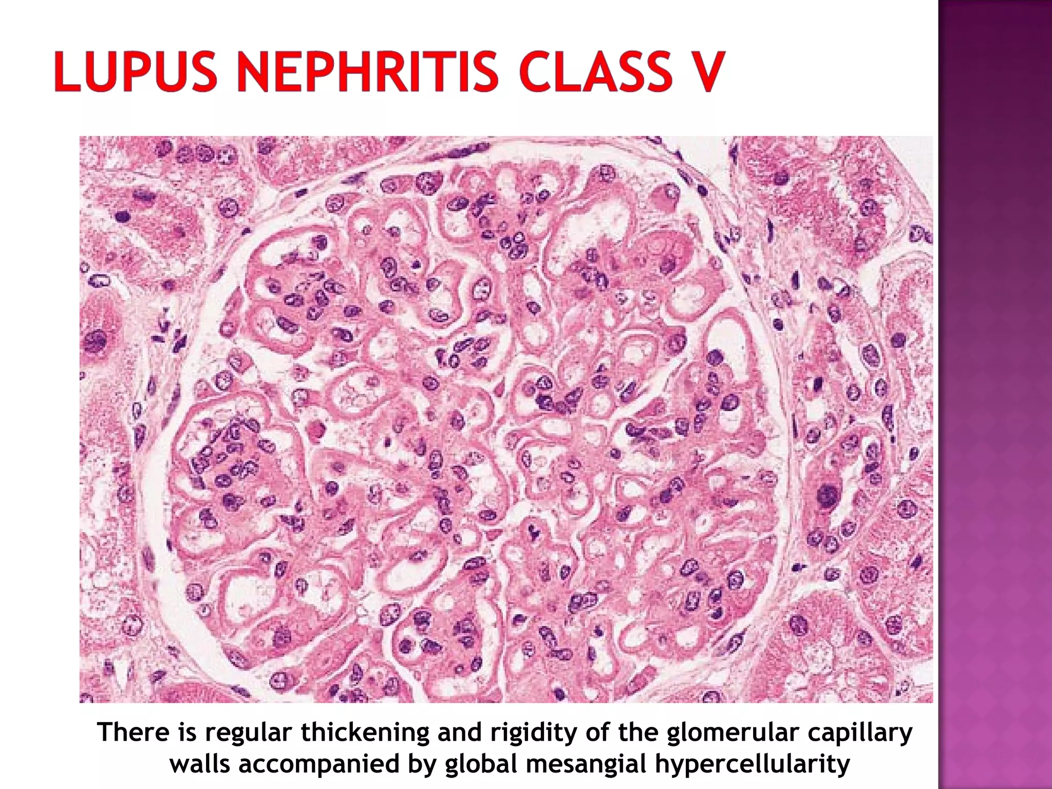 There is regular thickening and rigidity of the glomerular capillary
walls accompanied by global mesangial hypercellularity
 