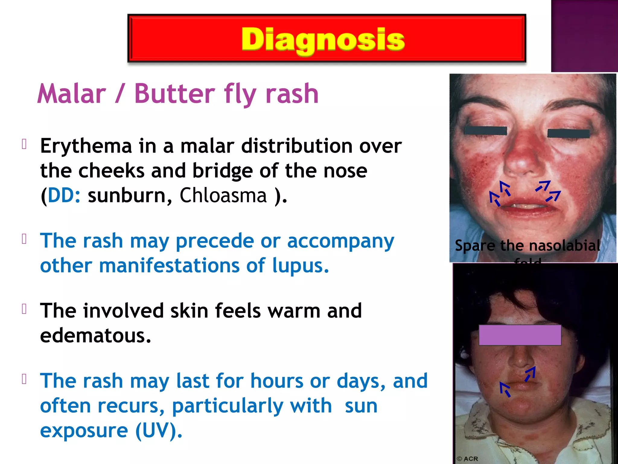 Malar / Butter fly rash
 Erythema in a malar distribution over
the cheeks and bridge of the nose
(DD: sunburn, Chloasma ).
 The rash may precede or accompany
other manifestations of lupus.
 The involved skin feels warm and
edematous.
 The rash may last for hours or days, and
often recurs, particularly with sun
exposure (UV).
Spare the nasolabial
fold
 