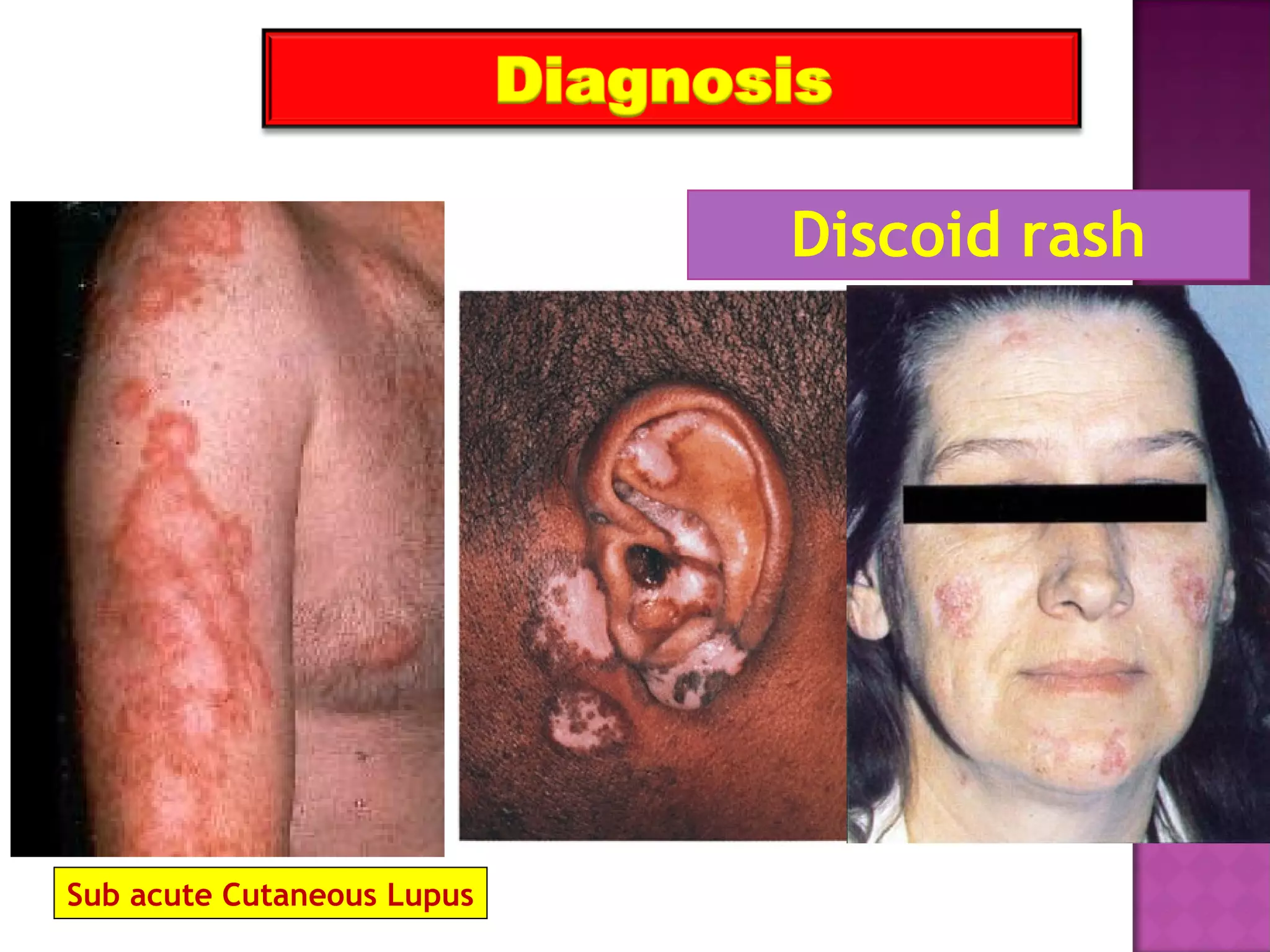 Discoid rash
Sub acute Cutaneous Lupus
 