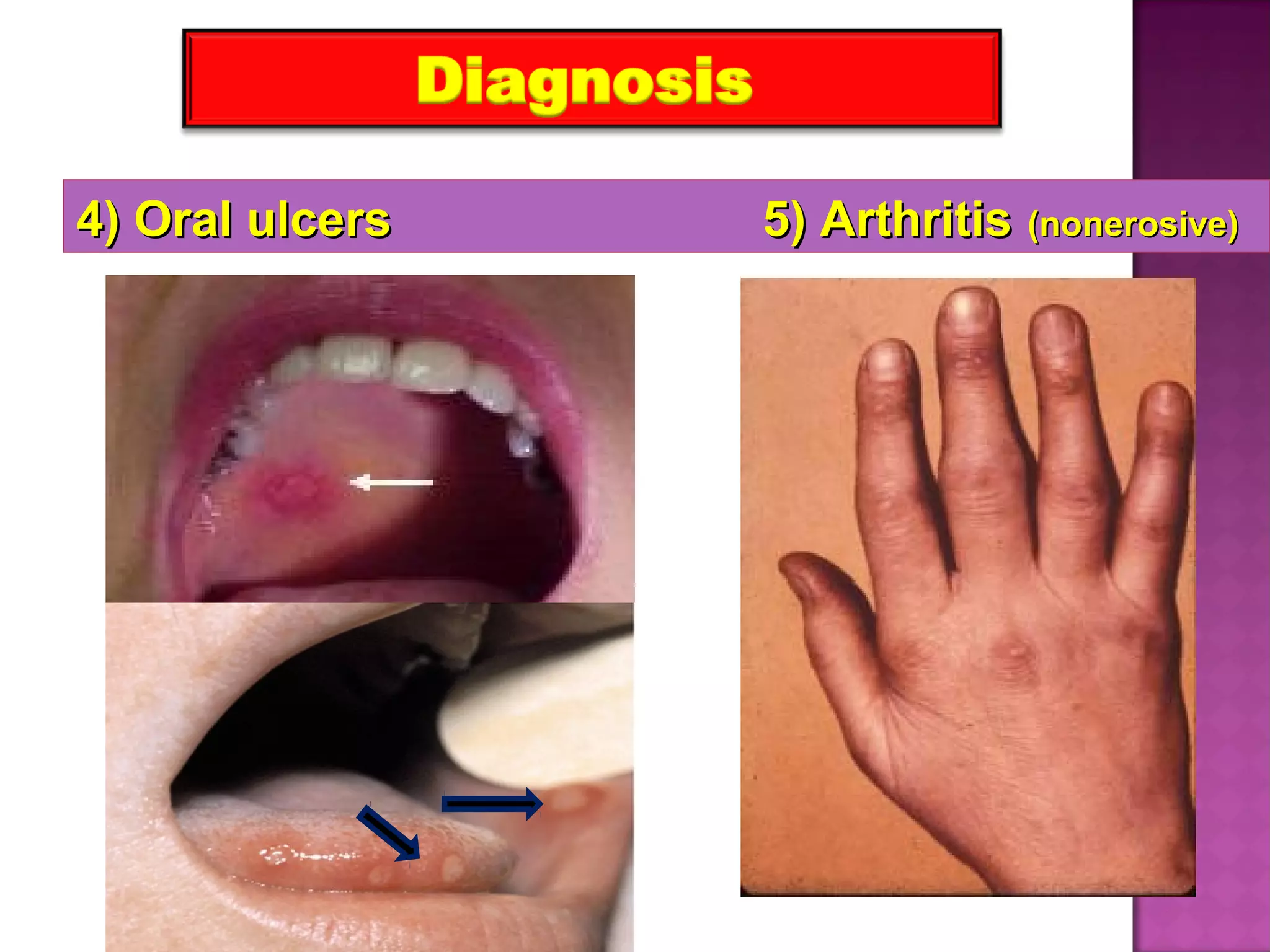 4) Oral ulcers 5) Arthritis4) Oral ulcers 5) Arthritis (nonerosive)(nonerosive)
 