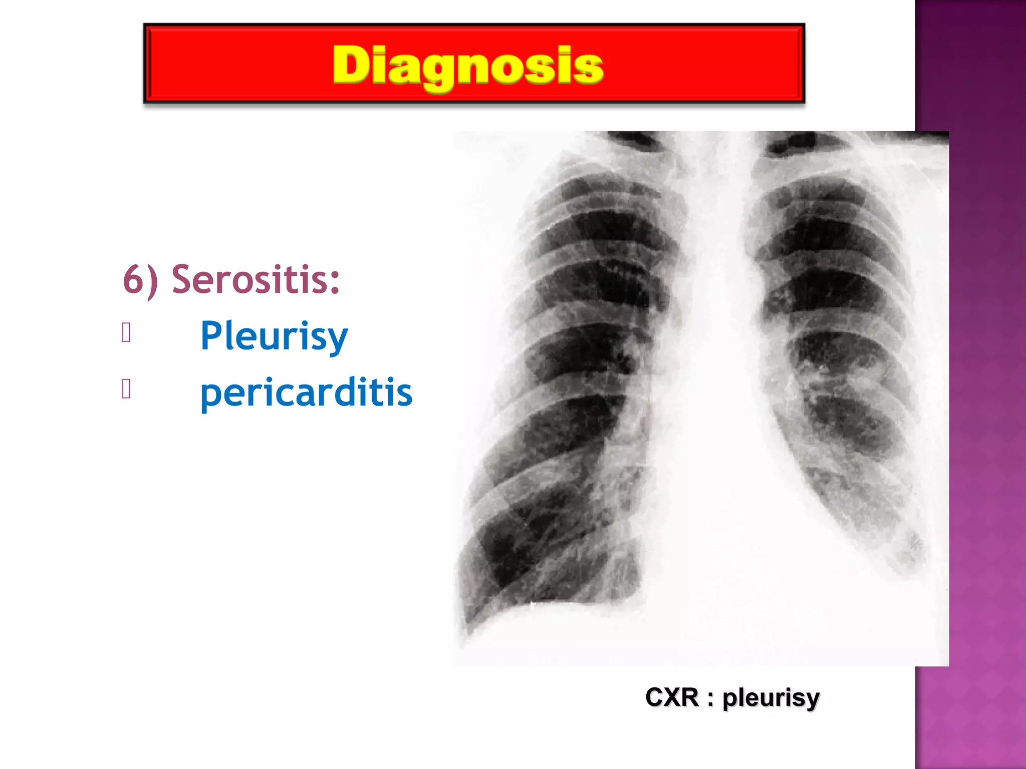 6) Serositis:
 Pleurisy
 pericarditis
CXR : pleurisyCXR : pleurisy
 