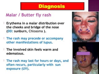 Lupus Nephritis Post Fff PPT lupus-nephritis-post-fff-ppt