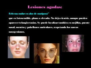 Eritema malaren alas de mariposa”
que es fotosensible, plano o elevado. No deja cicatriz, aunque pueden
aparecertelangiectasias. Se puede localizartambién en mejillas, puente
nasal, mentón y pabellones auriculares, respetando los surcos
nasogenianos.
Lesiones agudas:
 