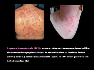 Lupus cutáneo subagudo (LCS): lesiones cutáneas eritematosas, fotosensibles,
de forma anularo papuloescamosa. Se suelen localizaren hombros, brazos,
cuello y tronco, y curan sin dejarcicatriz. Aprox. un 50% de los pacientes con
LCS desarrollan LES
 