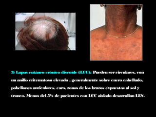 3) Lupus cutáneo crónico discoide (LCC): Pueden sercirculares, con
un anillo eritematoso elevado , generalmente sobre cuero cabelludo,
pabellones auriculares, cara, zonas de los brazos expuestas al sol y
tronco. Menos del 5% de pacientes con LCC aislado desarrollan LES.
 