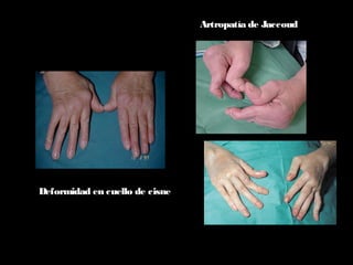 Artropatía de Jaccoud
Deformidad en cuello de cisne
 