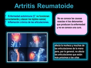  Enfermedad autoinmune (C’ no funcionan
correctamente y atacan los tejidos sanos)
 Inflamación crónica de las articulaciones.
No se conoce las causas
exactas ni los detonantes
que producen la enfermedad
y no se conoce una cura.
ferato.co
m
afecta la muñeca y muchas de
las articulaciones de la mano
pero, por lo general, no afecta
las articulaciones que están
más próximas a las uñas
 