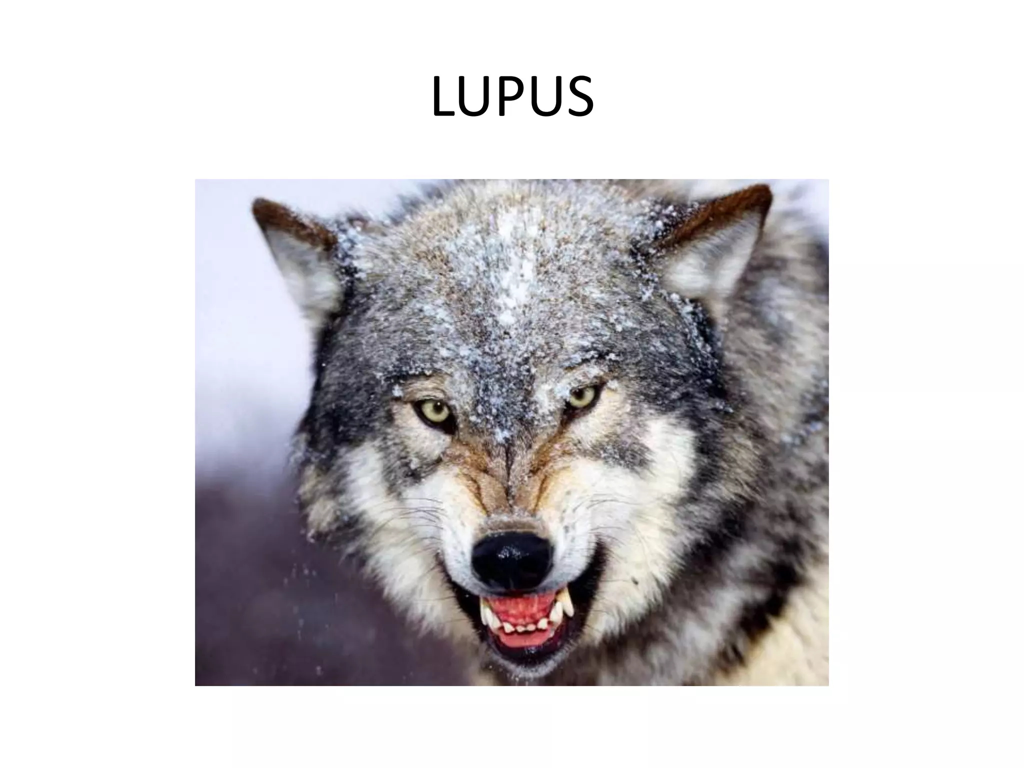 Lupus pneumonitis | PPT