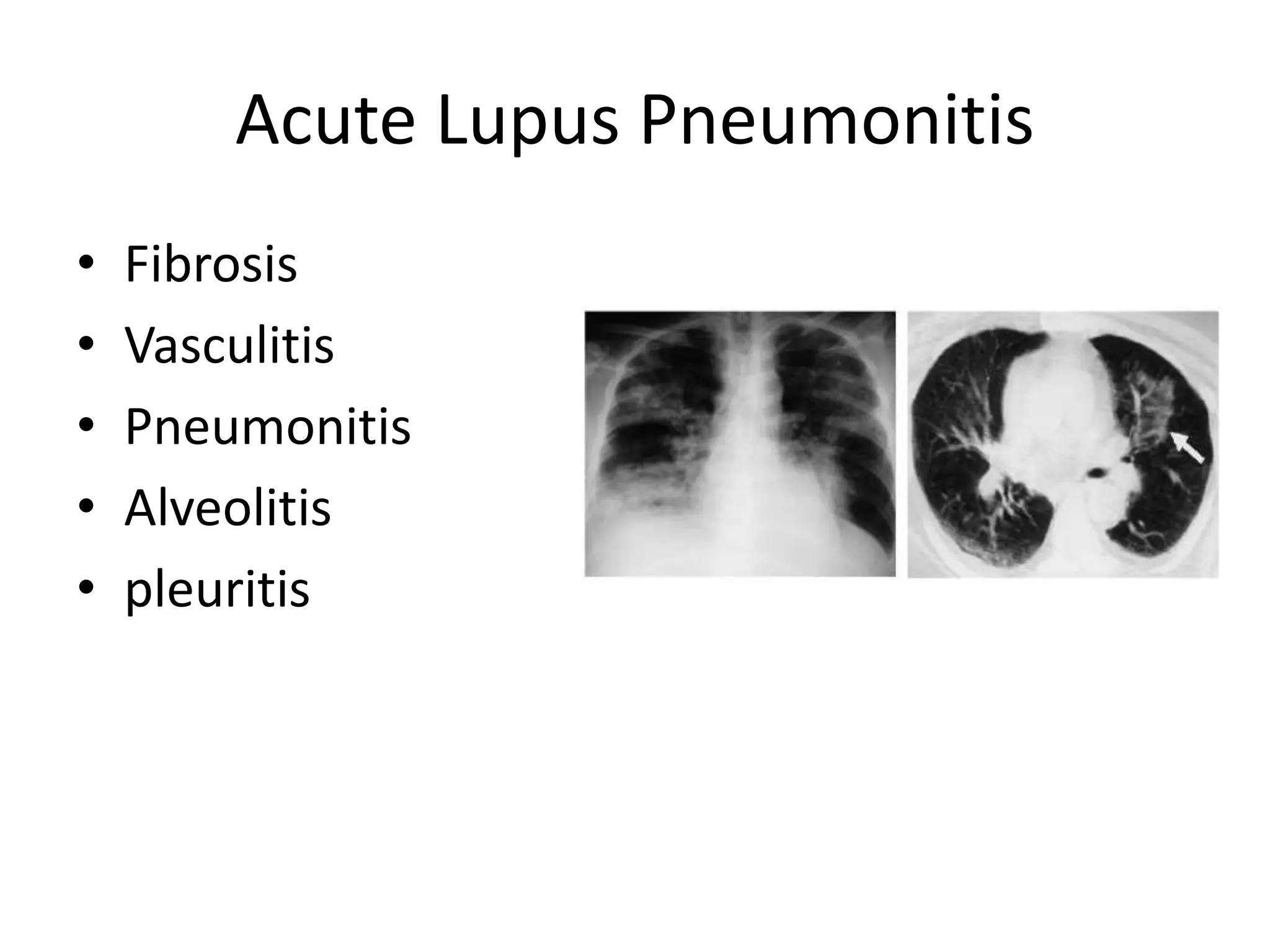 Lupus pneumonitis | PPT