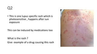 lupus quiz.pptx for knowing lupus thoroughly | PPT