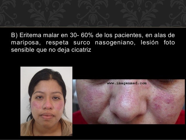 lupus bulloso