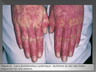                    Lupus érythémateux systémique : érythème du dos des mains respectant les articulations.(Figure 2).