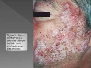 Figure 5 :  Lupus érythémateux discoïde : lésions érythémato-squameuses et atrophiques.