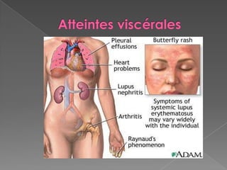 Atteintes viscérales